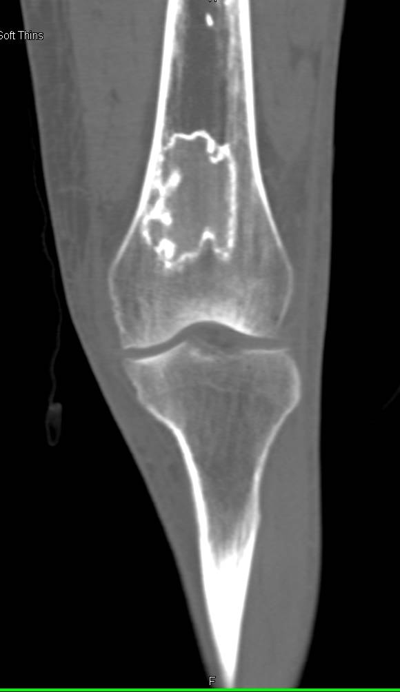 Bone Infarcts in the Distal Femur - Musculoskeletal Case Studies ...