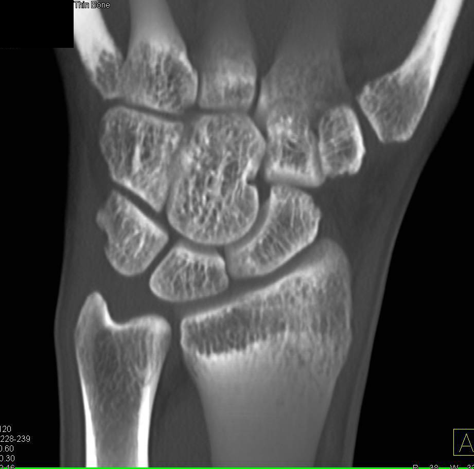 High Resolution Imaging of the Wrist - Musculoskeletal Case Studies ...