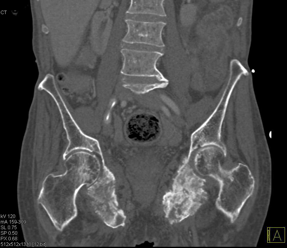 Widespread Blastic Bone Metastases from Prostate Cancer ...