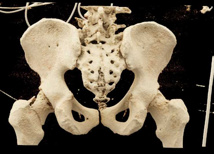 Left Femoral Neck Fracture - Musculoskeletal Case Studies - CTisus CT ...