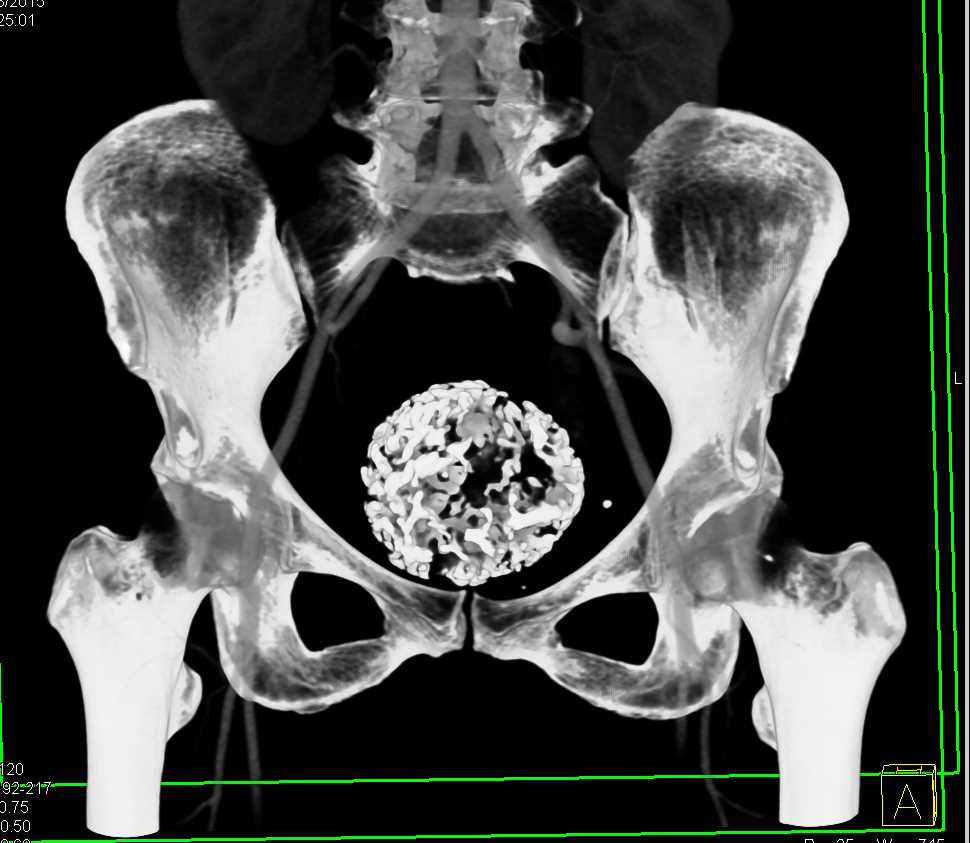 Calcified Uterine Fibroids - OB/GYN Case Studies - CTisus CT Scanning image.