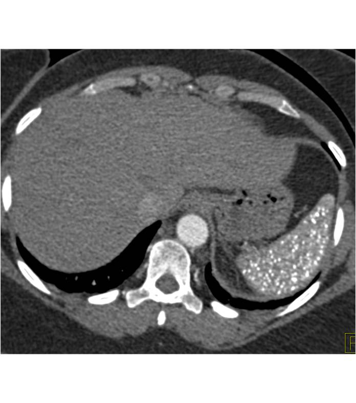 Splenic Granulomatous Disease - Spleen Case Studies - CTisus CT Scanning