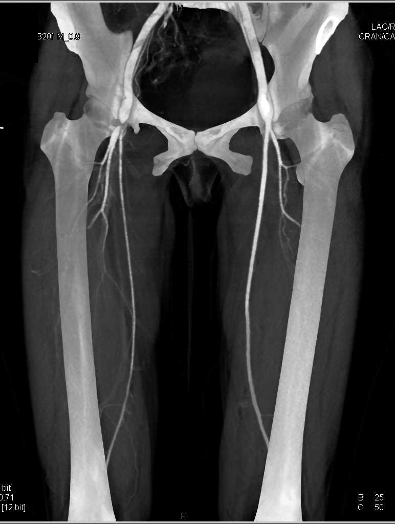 Superficial Femoral Artery Sfa Occlusion With Severe - vrogue.co