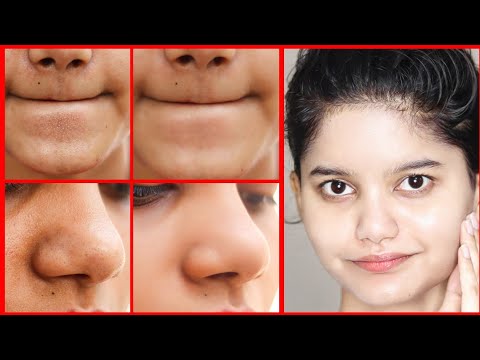 Remove BLACKHEADS WHITEHEADS CLOGED PORES Naturally | Permanent Results | Get Smooth Glowing Skin |