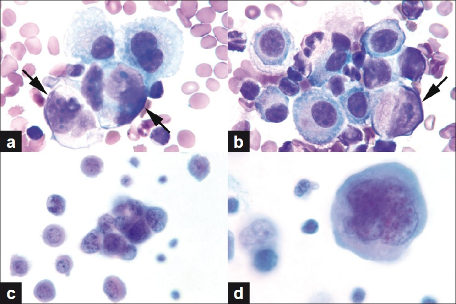 Alveolar Rhabdomyosarcoma Cytology