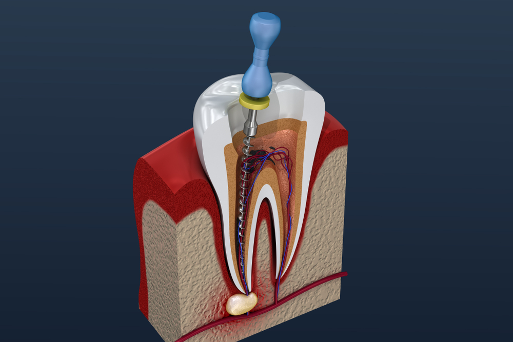 nhs root canal specialist near me - Bev Hamer