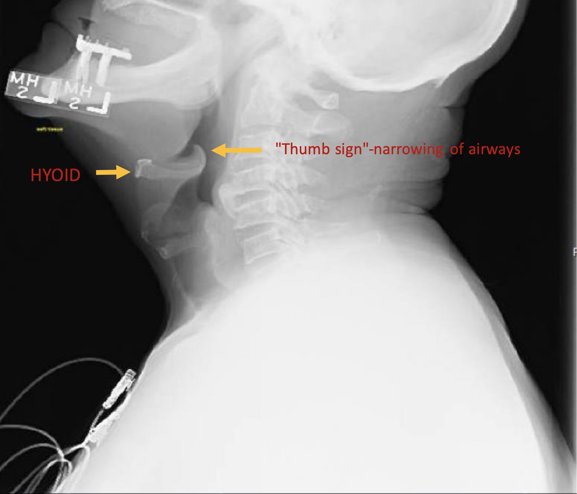 Thumb Sign Epiglottitis