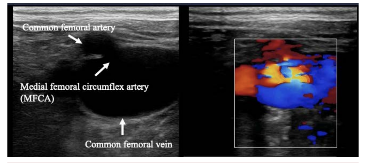 High-Output Heart Failure Caused by Femoral AV Fistula | VDM