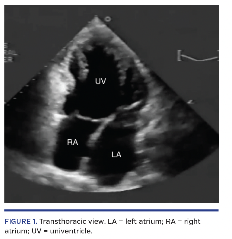 Uncorrected Univentricular Heart in an Adult