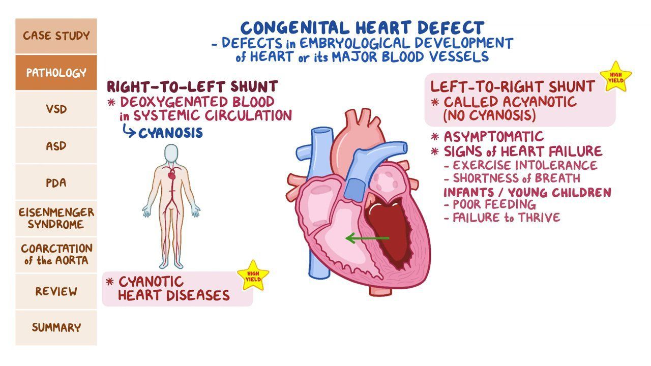 Common Types Of Congenital Heart Defects Children S Health - Vrogue