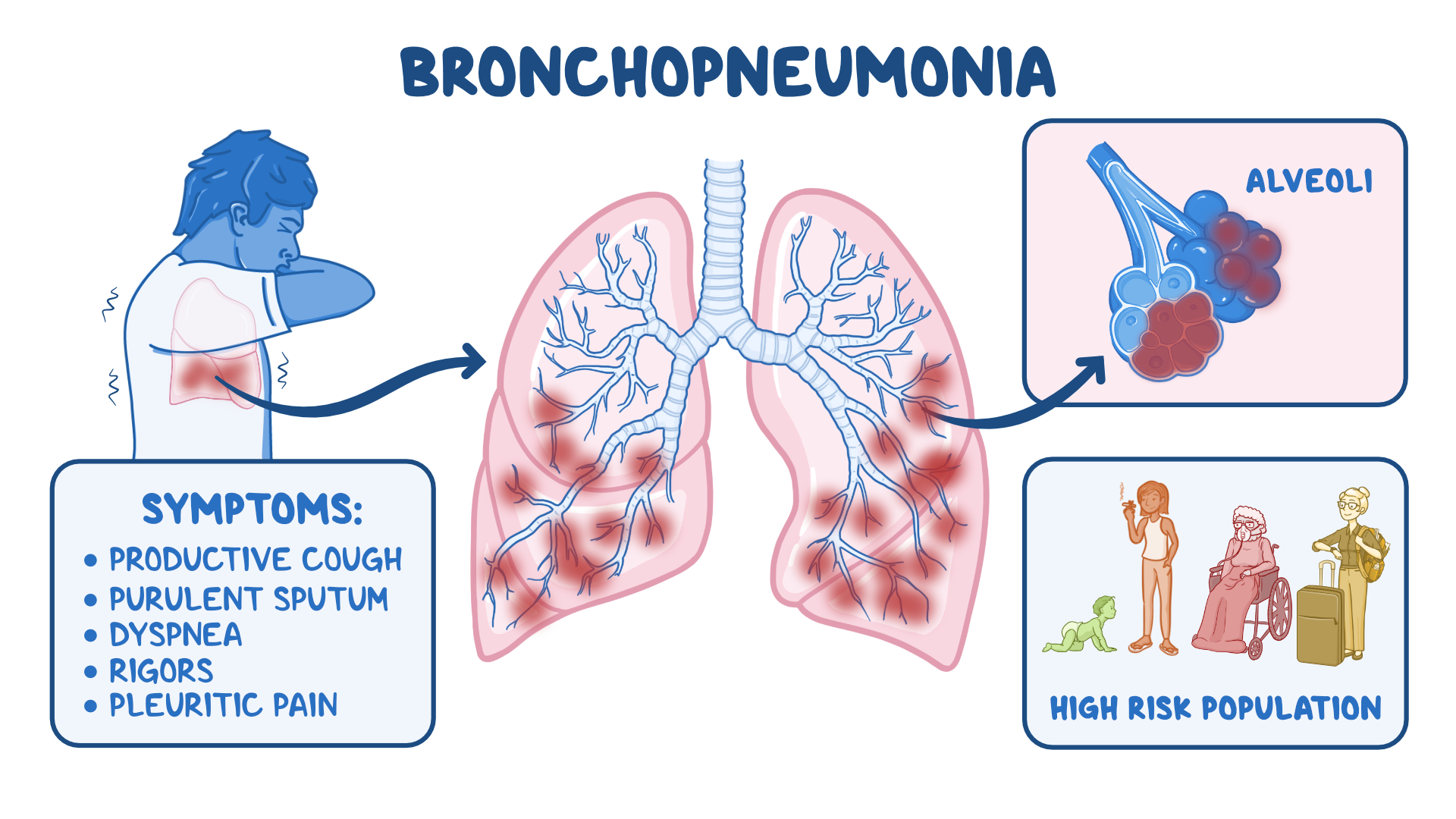 Bronkopneumonia Definisi Epidemiologi Penyebab Patofi - vrogue.co