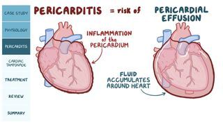 Cardiac Tamponade