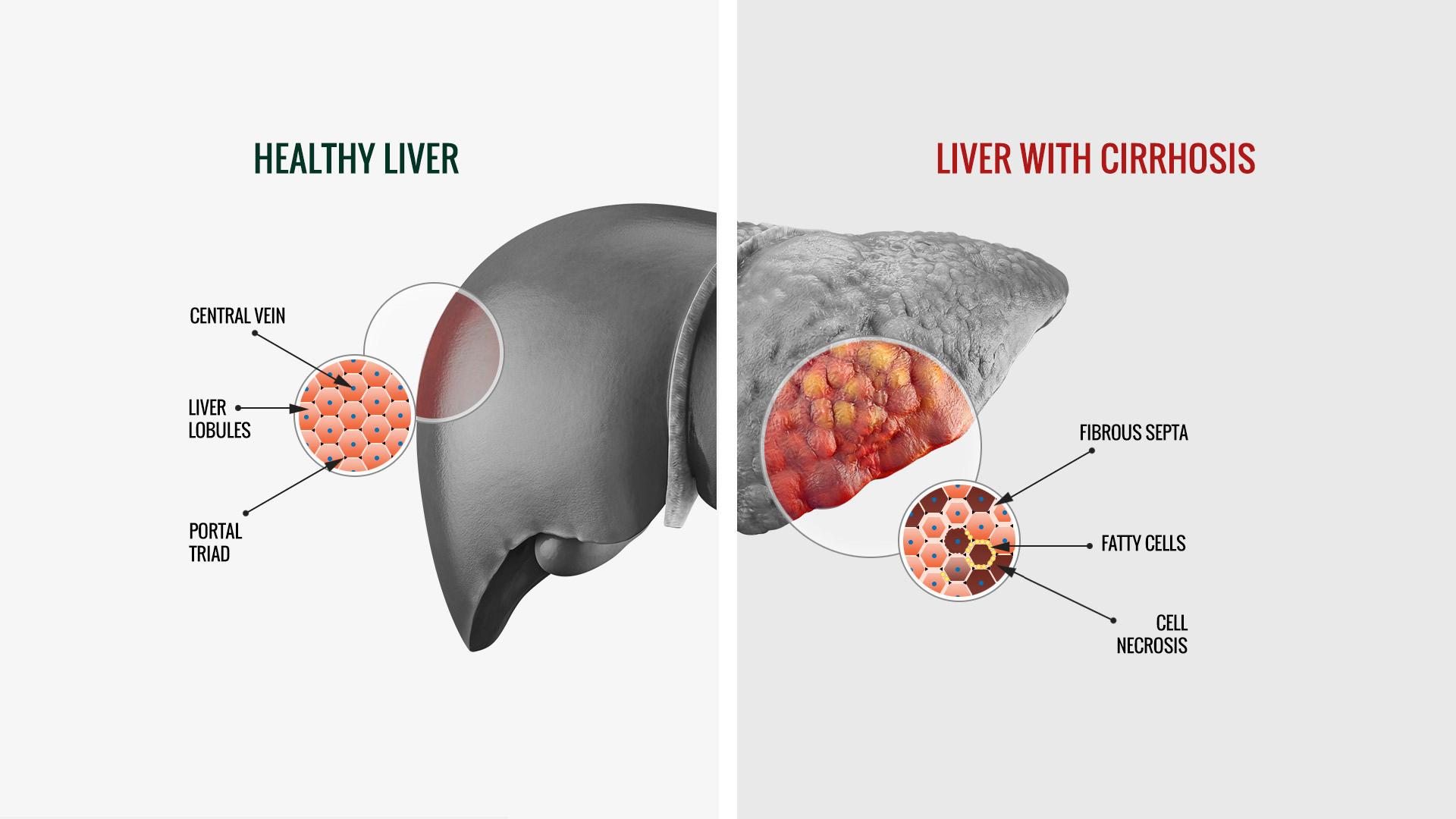 Hepatic Steatosis What Is It Causes Diagnosis Treatme - vrogue.co