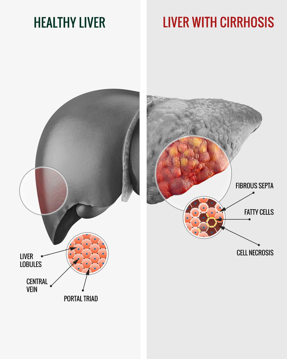 Hepatic Steatosis What Is It Causes Diagnosis Treatme - vrogue.co