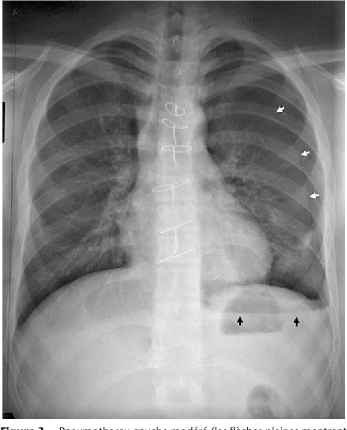 Figure 4 from Prise en charge d'un pneumothorax non traumatique ...