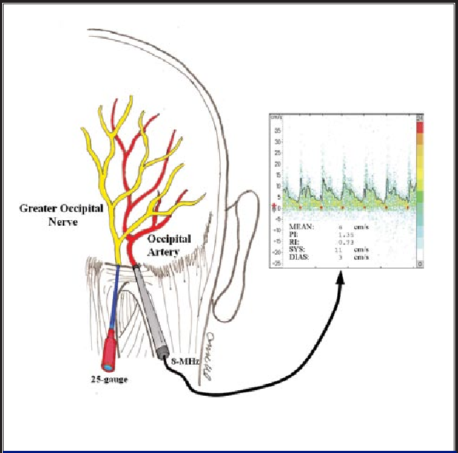 Greater Occipital Nerve