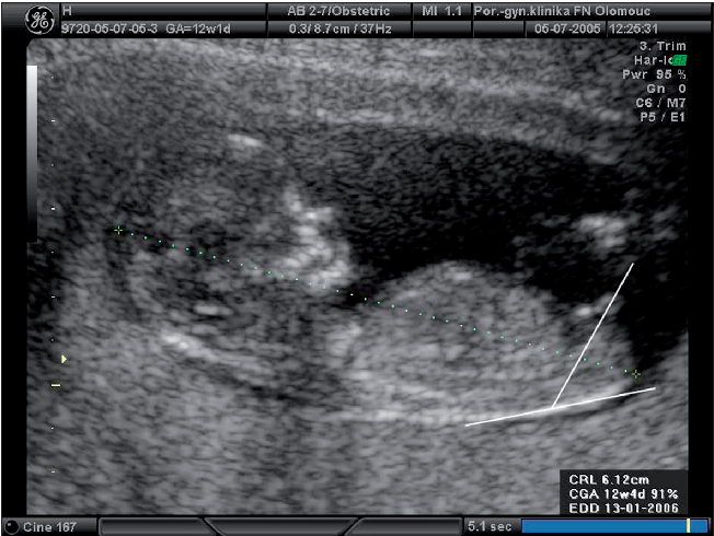 Figure 1 from Ultrasound evaluation of fetal gender at 12-14 weeks ...