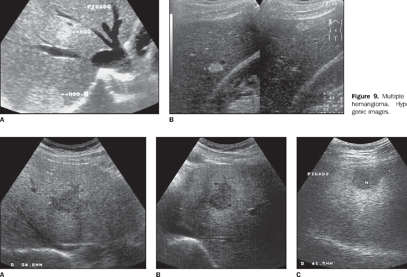 Liver Hematoma Ultrasound