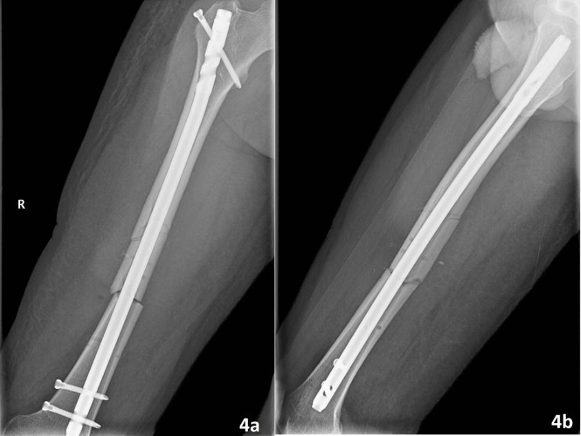 Femoral Shaft Fracture