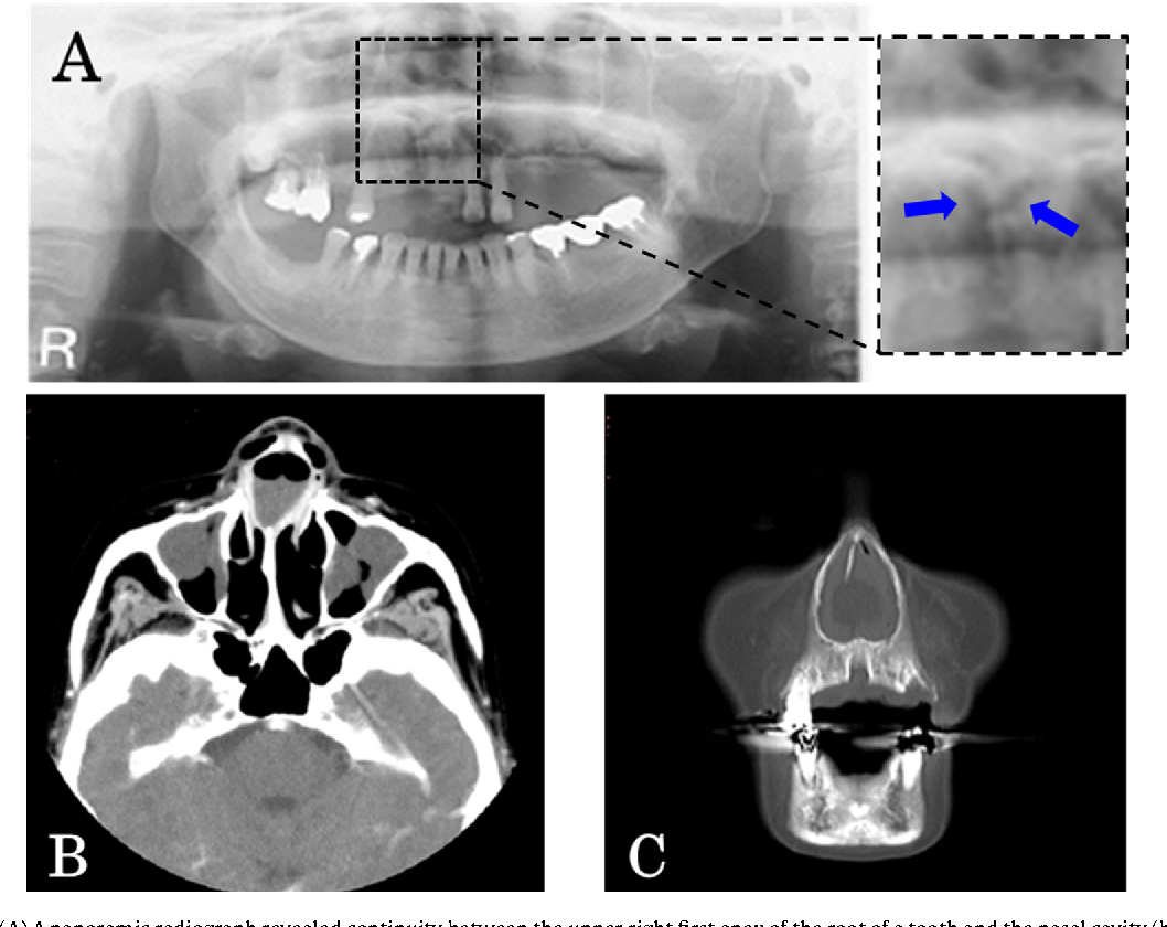 A case of nasal septal abscess caused by medication related ...