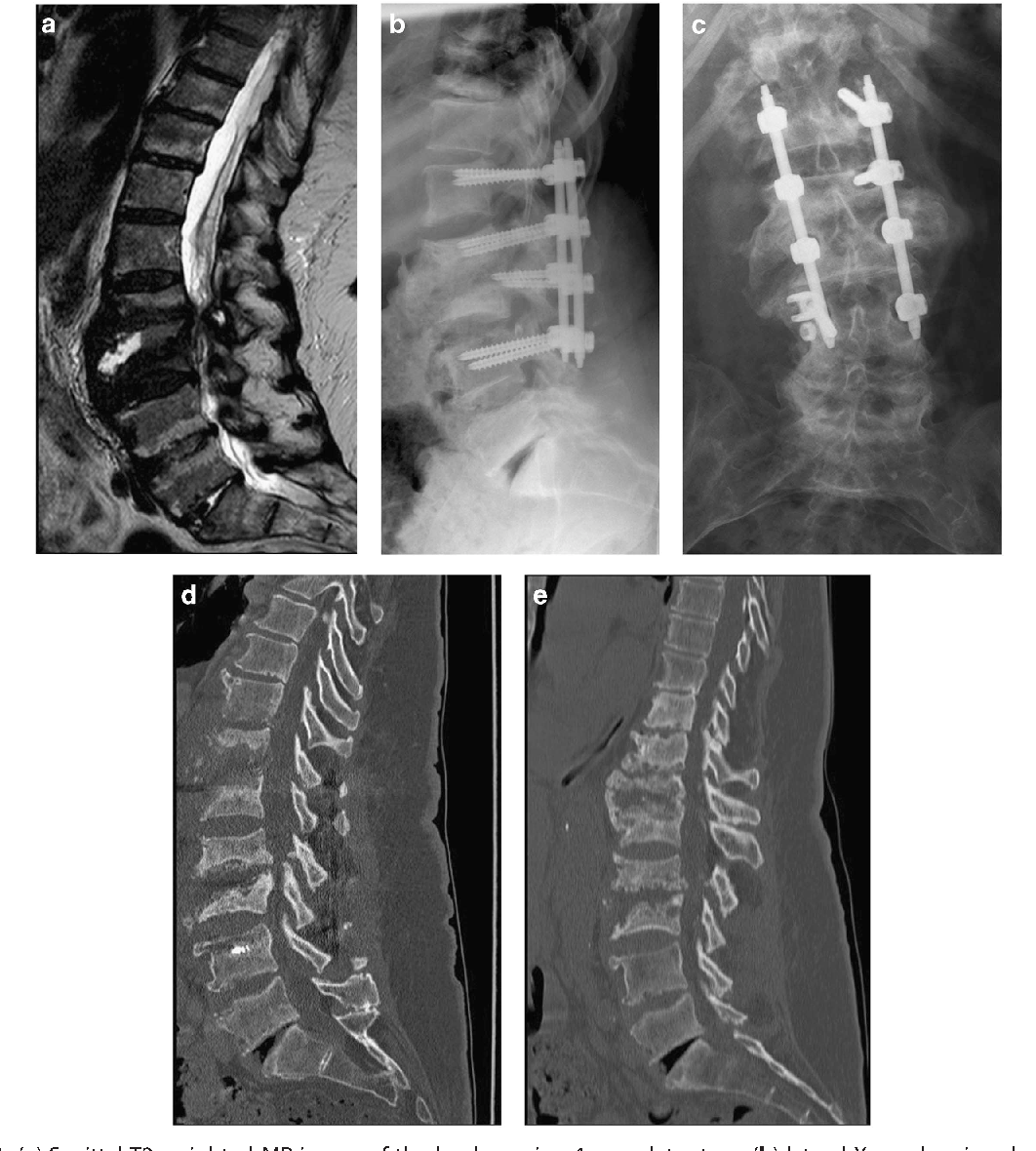 [PDF] Charcot spinal arthropathy: an increasing long-term sequel after ...