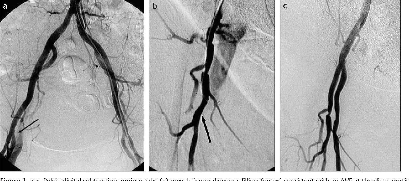 [PDF] Iatrogenic femoral arteriovenous fistula: endovascular treatment ...