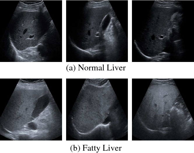 Normal Liver Ultrasound