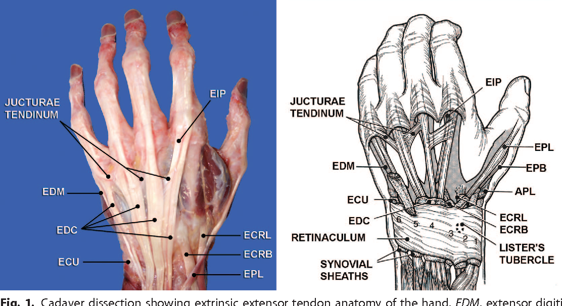 Finger Extensor Tendon Injury Definition Causes Sympt - vrogue.co