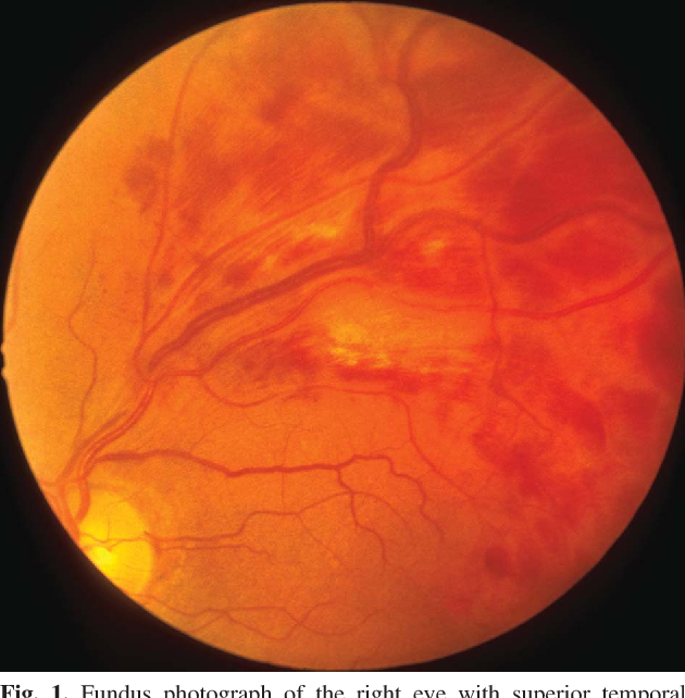 Figure 1 from Fundus changes in branch retinal vein occlusion ...