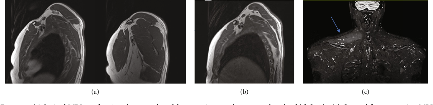 [PDF] Spinal Accessory Nerve Injury following Spinal Adjustment: Case ...