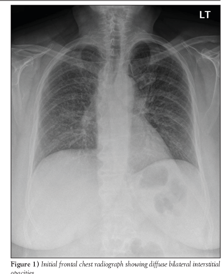 [PDF] Methotrexate-induced pulmonary toxicity. | Semantic Scholar