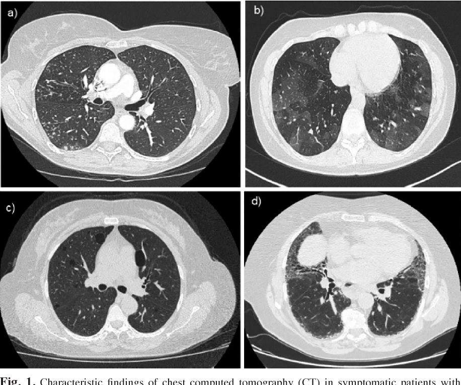 Figure 1 from Prevalence and spectrum of symptomatic pulmonary ...