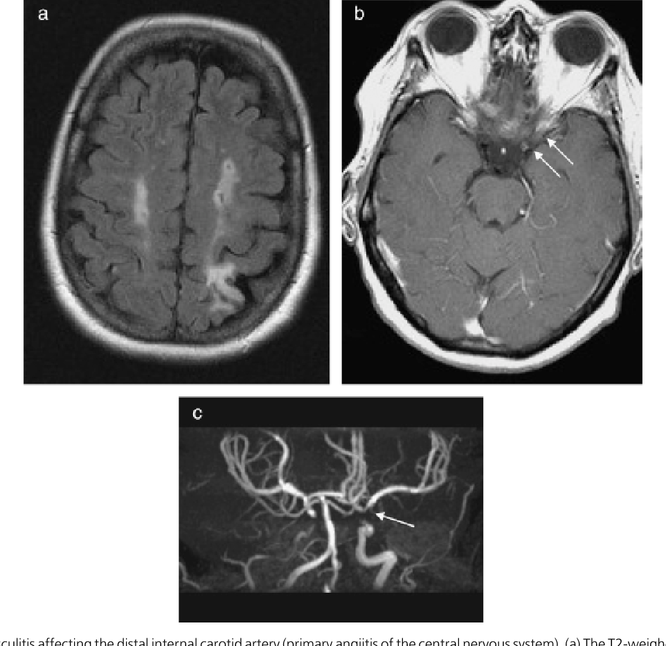 Pipeline Linse Tagesanbruch kawasaki disease cerebral vasculitis ...