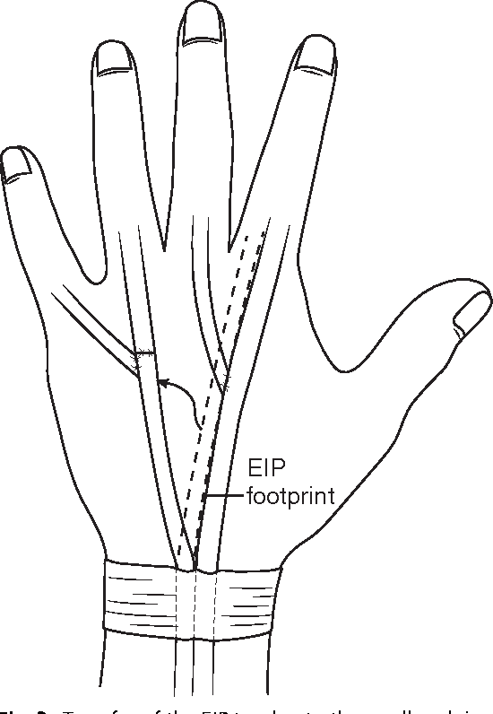 Figure 3 from Tendon Transfers in the Rheumatoid Hand for ...