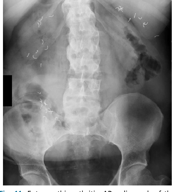 Figure 1 from Imaging of the seronegative spondyloarthopathies ...