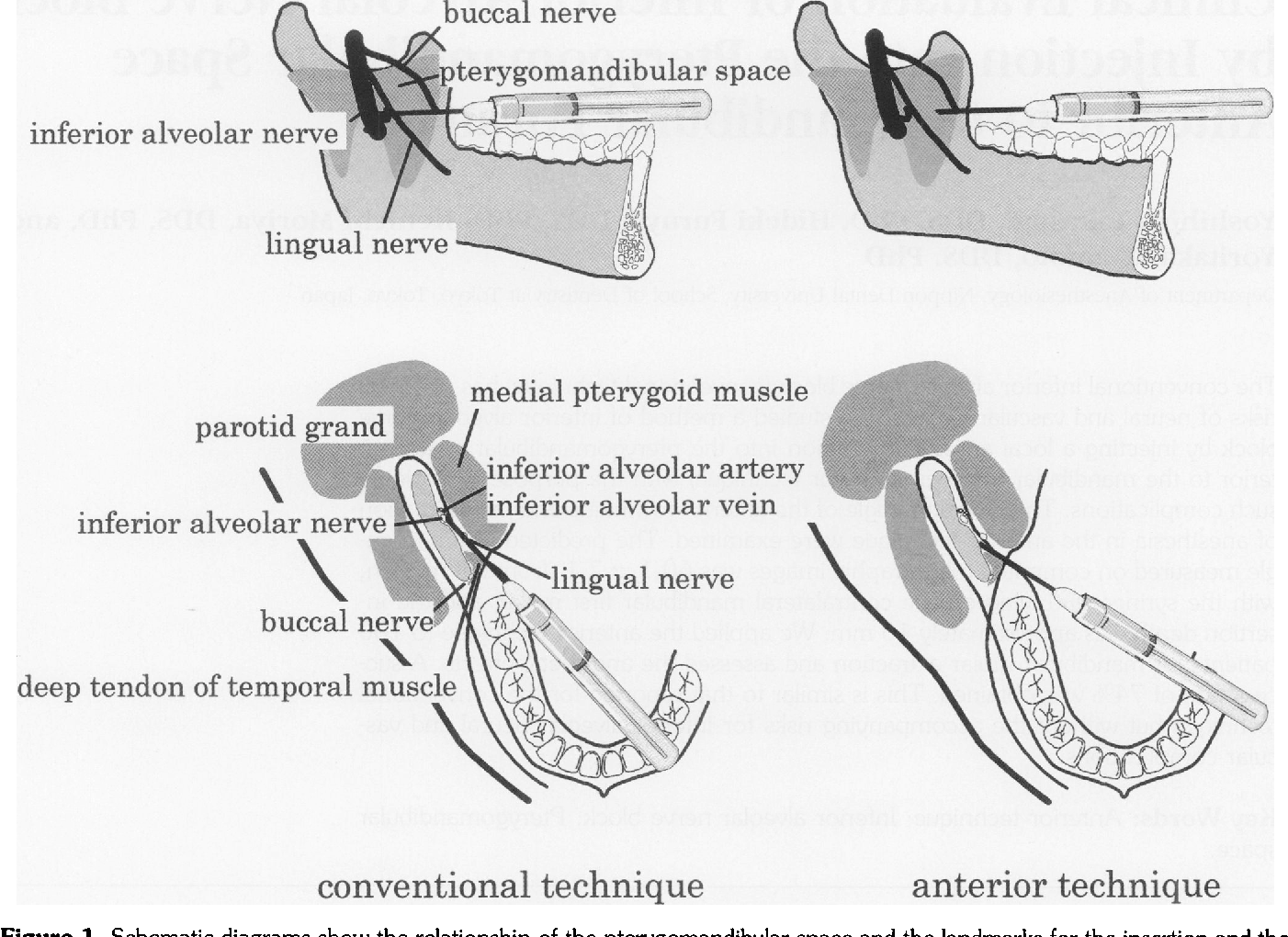 Inferior Alveolar Nerve Block Landmarks