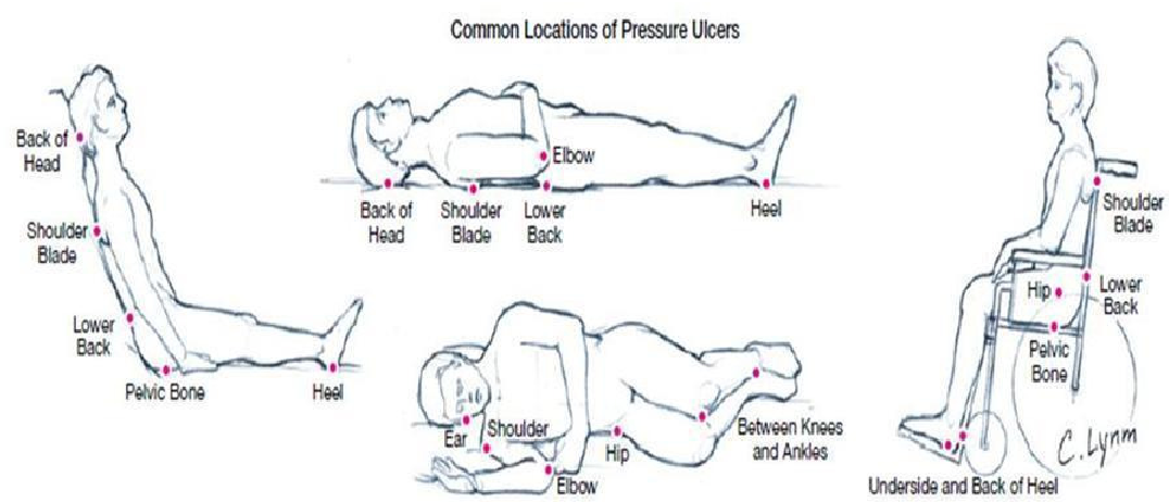 [DIAGRAM] Pressure Ulcer Pressure Points Diagrams - MYDIAGRAM.ONLINE