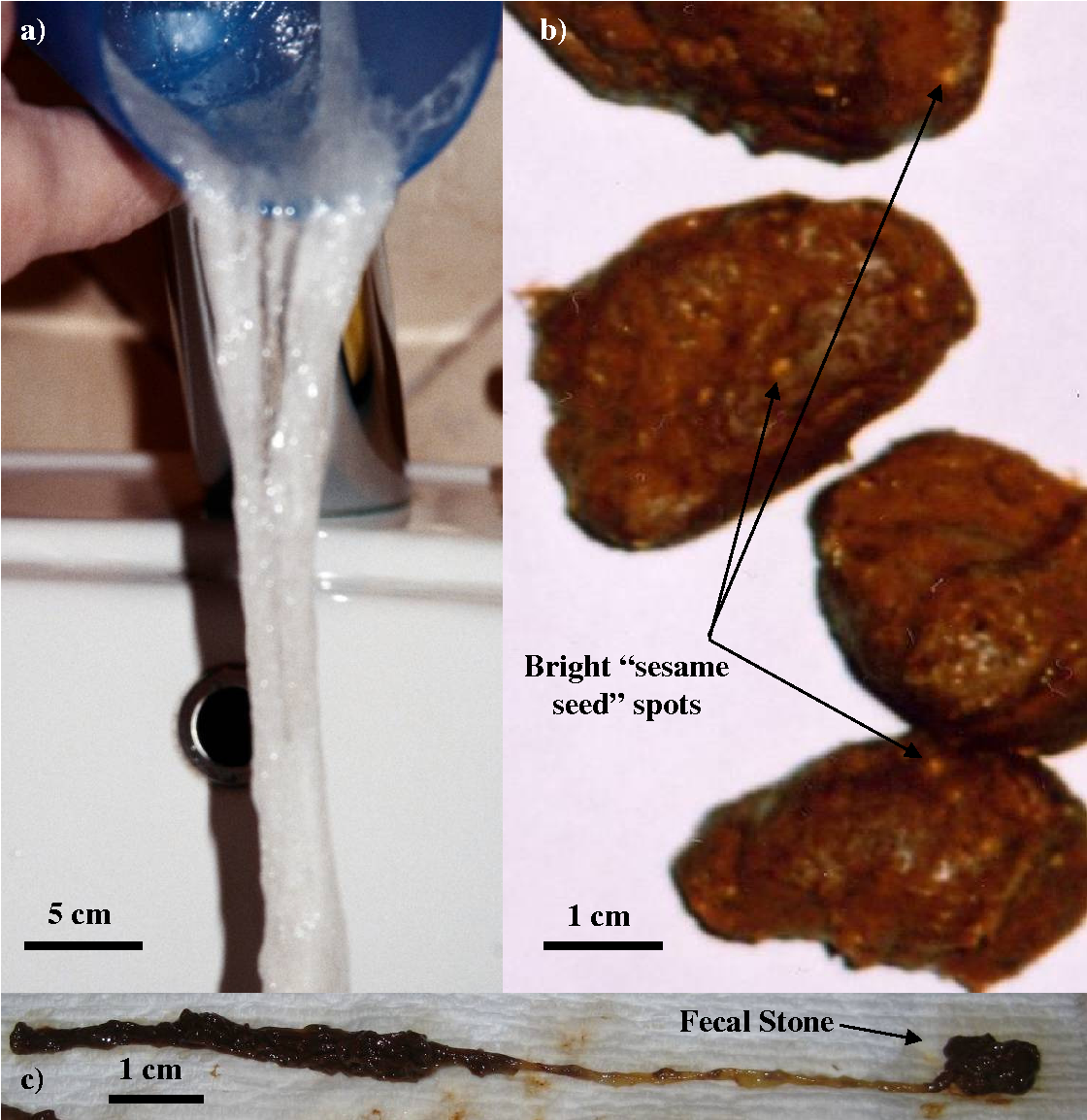 Human Poop With Worms Pictures