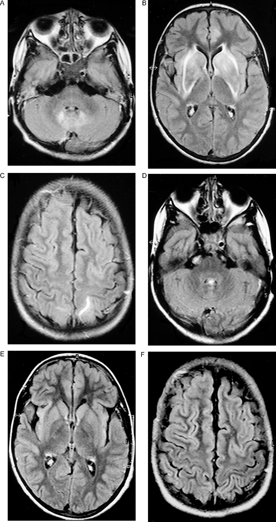 Lentiform fork sign in a child with dialysis disequilibrium syndrome: A ...