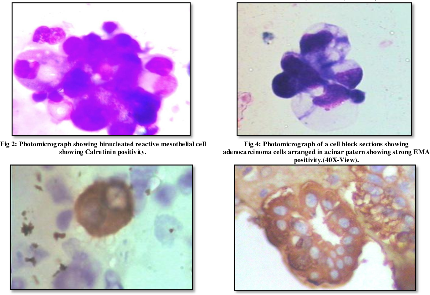 Table 1 from Cytological evaluation of peritoneal fluid with special ...