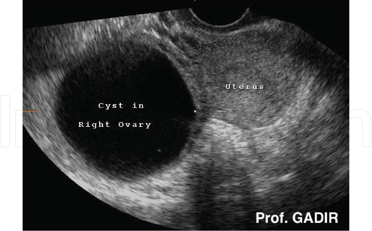 Ovary Cyst While Pregnant