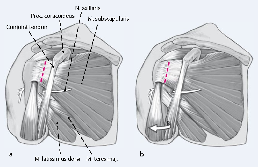 Conjoint Tendon Shoulder Anatomy Shoulder Tendon Anat - vrogue.co