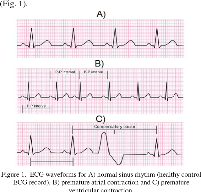 Premature Atrial Contractions