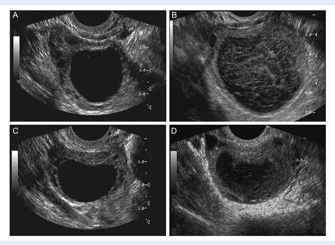 [PDF] Follicle growth and endocrine dynamics in women with spontaneous ...