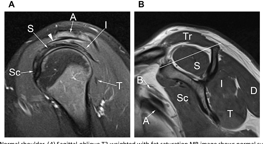 Normal Shoulder MRI Anatomy