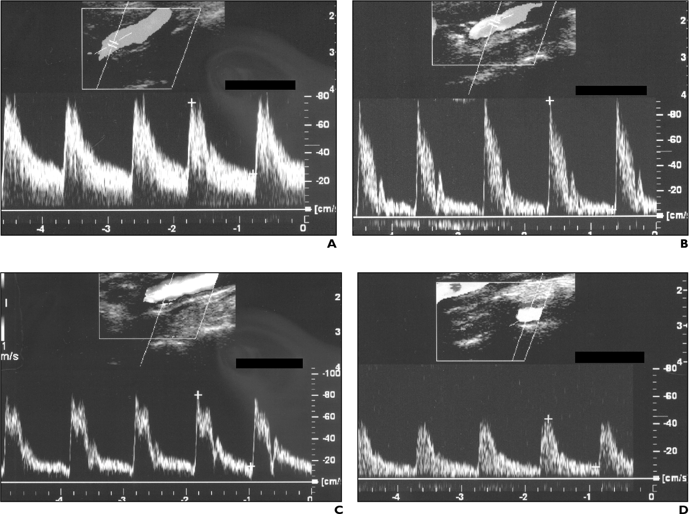 Carotid Ultrasound Waveforms