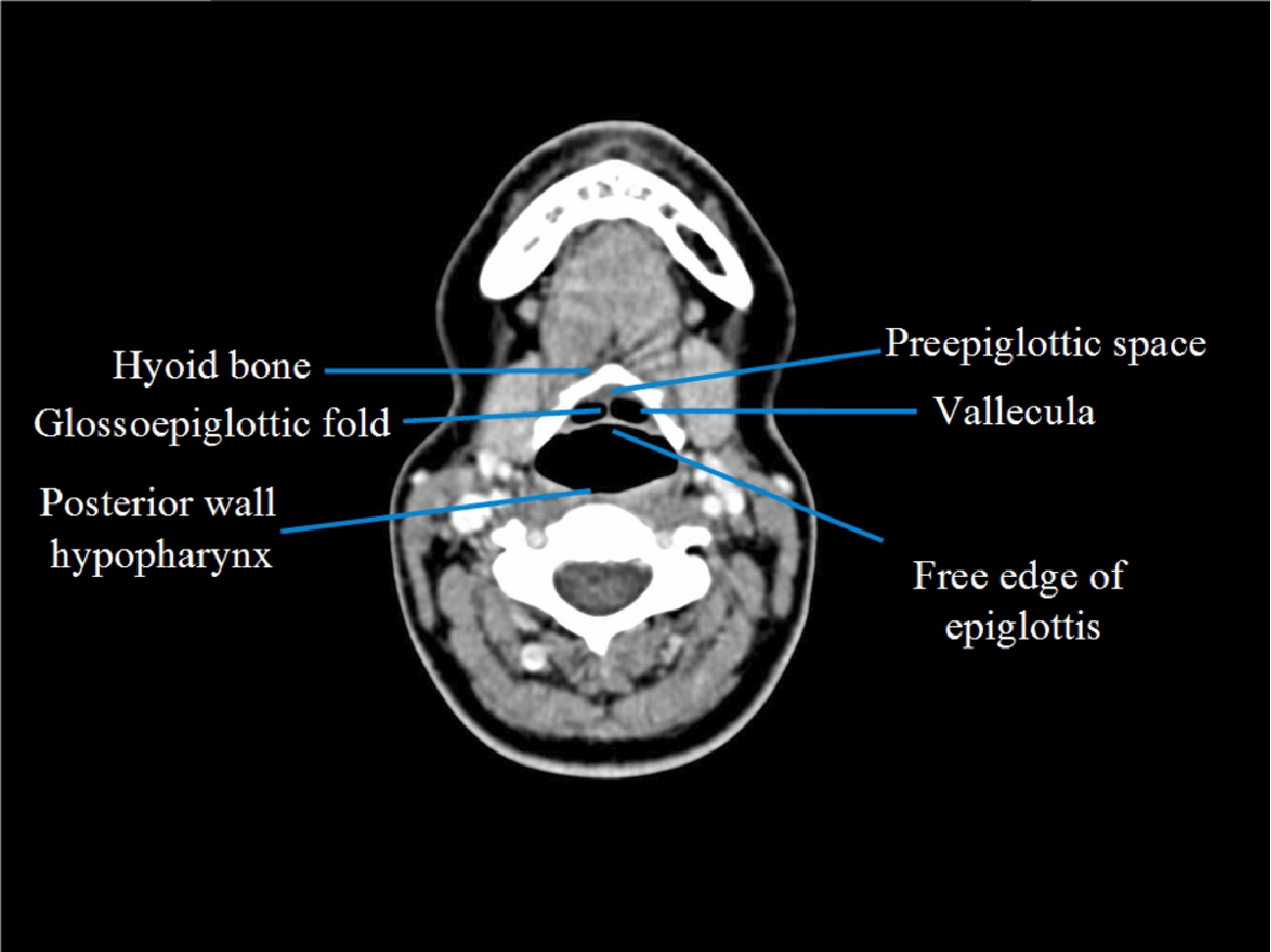 Supraglottic Larynx Anatomy