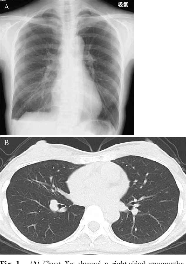 Figure 1 from Catamenial pneumothorax with intrathoracic disseminated ...