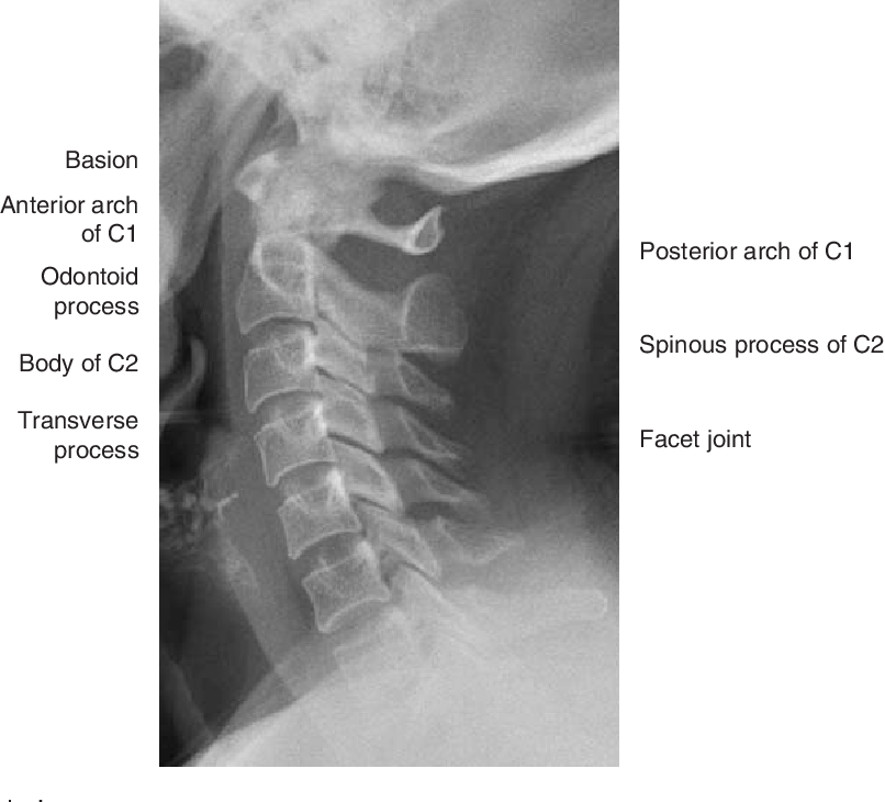 Atlanto Occipital Joint Xray