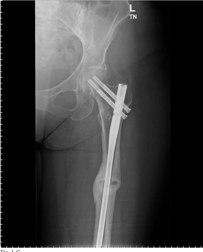 Figure 2 from Atypical Femoral Fracture Despite Prophylactic ...